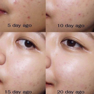 Bộ Kit Dưỡng Da Mụn Some By Mi AHA – BHA – PHA 30 Days Miracle AC SOS Kit