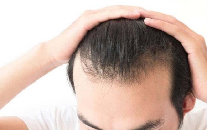 Vì sao nên dùng dầu gội mọc tóc cho nam