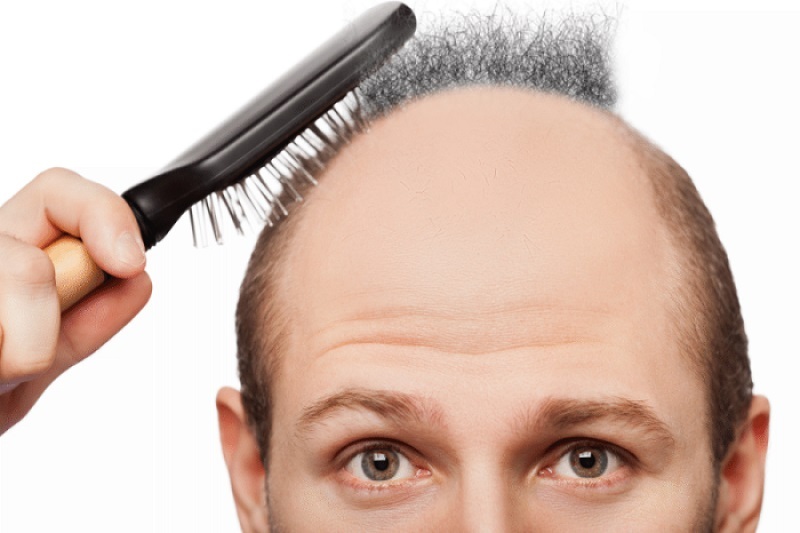 5 loại dầu gội ngăn ngừa rụng tóc cho nam hiệu quả