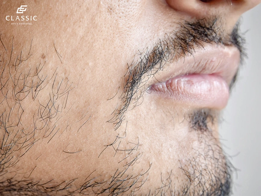 cải thiện nhanh râu mọc không đều với 4 bước tự dưỡng tại nhà