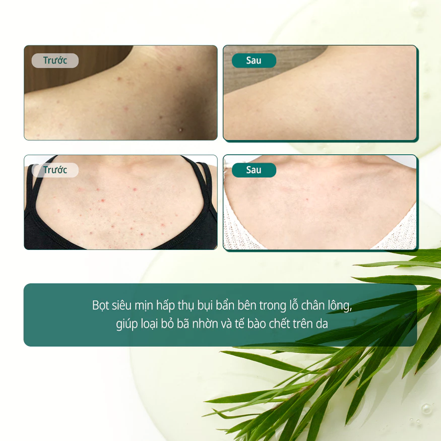 Sữa tắm cho da mụn AHA-BHA-PHA 30 Days Miracle Acne Clear Body Cleanser 400g